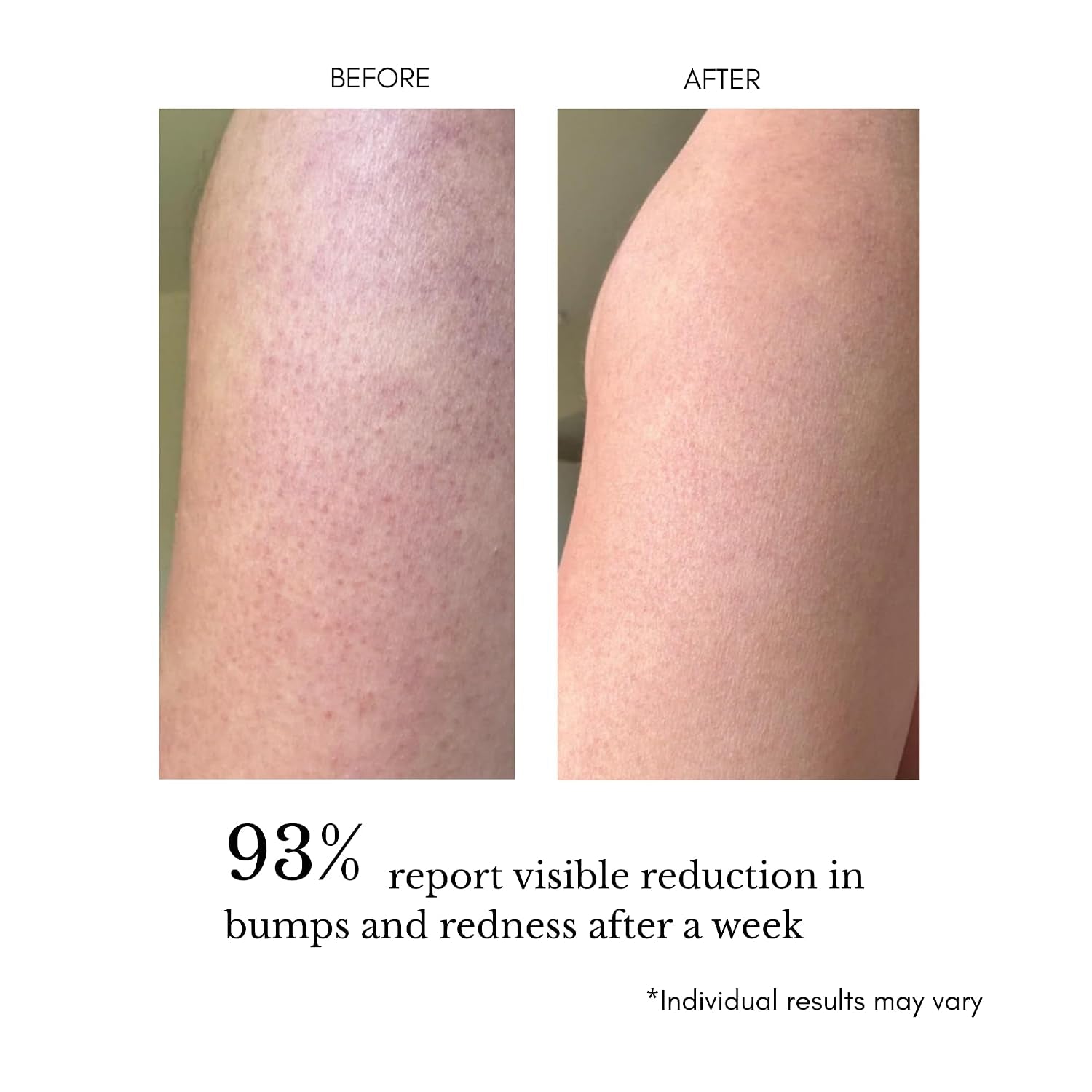 KP serum being applied to smooth bumpy skin on the arm